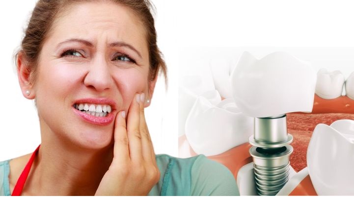 Dental Implants